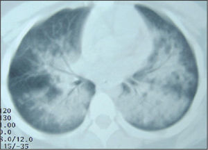 Tomografía computarizada de tórax. Patrón alveolar difuso generalizado que afecta a ambos campos pulmonares, de predominio parahiliar.