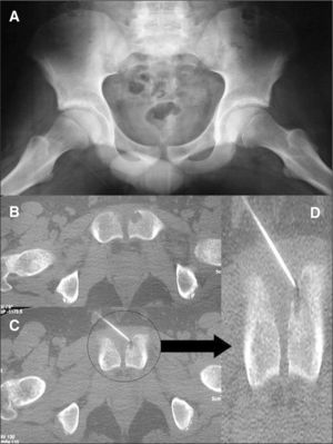 (A) Radiografía anteroposterior de pelvis informada como normal. (B) Imágenes de la tomografía computarizada que muestra la erosión ósea, la toma de biopsia con aguja fina (C) y detalle de la misma (D) que muestra que la punción-aspiración con aguja fina se realizó del interior de la lesión.