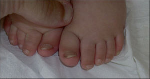 Engrosamiento, coloración amarillo-marronácea distal y desviación lateral externa de la uña del primer dedo de ambos pies.