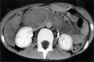 TC abdominal sin contraste intravenoso: afectación de la pared duodenal con extensión desde la segunda porción duodenal hasta el ángulo de Treitz.