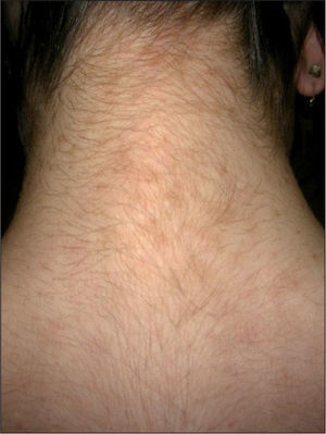 Pápulas parduscas finamente descamativas y confluentes en la cara posterior del cuello.
