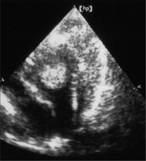 Ecocardiografía que muestra rabdomioma en el ventrículo izquierdo.