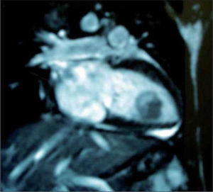 Angiorresonancia que muestra el mismo rabdomioma en el ventrículo izquierdo.