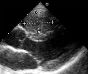 Ecocardiografía de un fibroma que produce protrusión en el tracto de salida del ventrículo izquierdo.