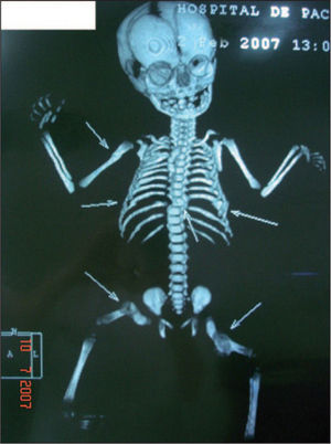 Flechas en la tomografía computarizada que señalan fracturas múltiples de distinta fecha. Columna vertebral con fractura en el cuerpo vertebral con desviación del eje. Ambos fémures se ven osteopénicos, con fracturas metafisarias en recuperación.