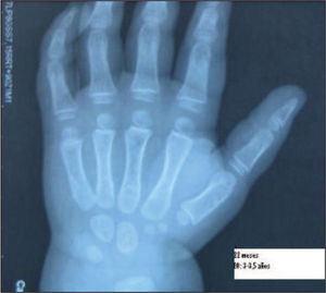 Radiografía de mano izquierda. Edad ósea correspondiente a 3–3,5 años a una edad de 22 meses.