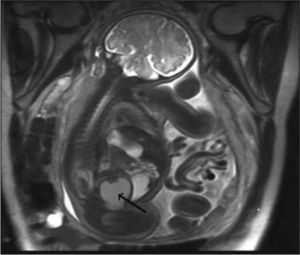 Resonancia magnética (RM) fetal que muestra tumoración pélvica (flecha) que comprime vejiga y ureterohidronefrosis.