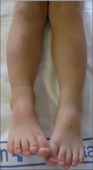Lesiones compatibles con eritema nudoso en el momento del ingreso.
