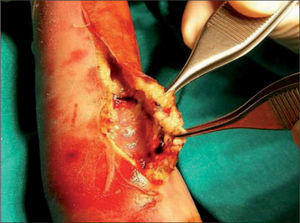 Desbridamiento quirúrgico de la escara necrótica, con evidencia de vasos subcutáneos trombosados.