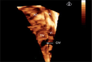 Ecocardiografía 3D en tiempo real de comunicación interventricular muscular grande visualizada desde el ventrículo derecho (flecha). Se aprecia toda la superficie del tabique interventricular (parte de la pared libre del ventrículo derecho se ha recortado para una mejor visualización del defecto). AD: aurícula derecha; AI: aurícula izquierda; CIV: comunicación interventricular; TIV: tabique interventricular; VD: ventrículo derecho; VI: ventrículo izquierdo.