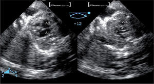 Modo biplano fetal en un corazón normal. Desde una proyección apical, con cuatro cámaras y con una única ventana acústica, con una inclinación vertical, se ha obtenido simultáneamente el plano ecocardiográfico fetal “tres vasos” con la vena cava superior, aorta y pulmonar bifurcándose en sus dos ramas. A: aorta; AD: aurícula derecha; AI: aurícula izquierda; P: arteria pulmonar; VCS: vena cava superior.