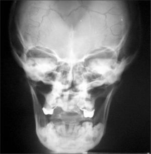 Radiografía de cráneo. Se observa la hipoplasia de maxilar superior.