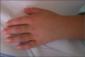 Lesiones eritematoso-violáceas sobre el dorso de los nudillos y eritema periungueal.