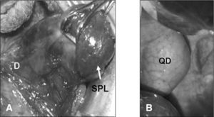 A) Secuestro pulmonar extralobar (SPL), en el interior del diafragma (D). B) Quiste dermoide mediastínico (QD).