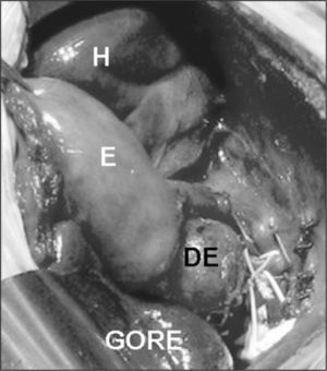 Duplicación esofágica (DE) situada a la entrada del estómago (E). Reparación del defecto diafragmático con placa de Gore-Tex®.