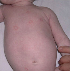 Placas anulares eritematosas no descamativas localizadas en el tronco.