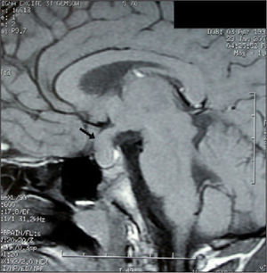 RM cerebral al diagnóstico, corte sagital. Tumoración selar de 16mm X 18mm con extensión supraselar.
