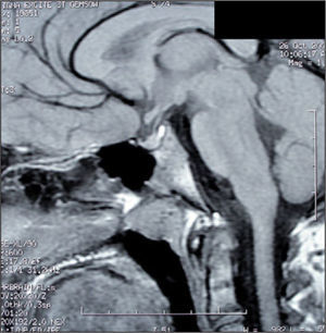RM cerebral a los 9 meses del diagnóstico, corte sagital. Tumoración selar residual. Ausencia de extensión supraselar.