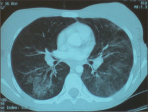 TC pulmonar con infiltrados alveolares bilaterales.