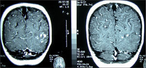 Resonancia magnética cerebral, que muestra la existencia de múltiples lesiones compatibles con tuberculomas cerebrales.