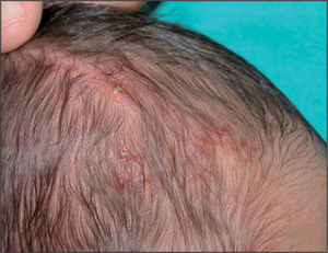 Pápulas y pústulas de base eritematosa en cuero cabelludo.