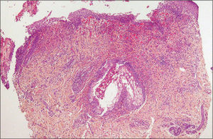 Imagen histológica panorámica de la biopsia cutánea. Puede observarse un denso infiltrado inflamatorio predominantemente eosinfílico y mixto perifolicular e intersticial dérmico, con afectación de la glándula sebácea, así como espongiosis y exocitosis de eosinófilos en la epidermis.