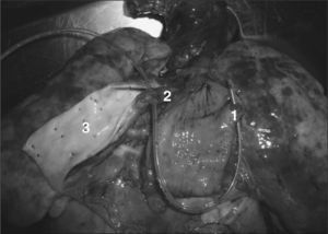 Pieza de la necropsia del corazón y grandes vasos. 1, fístula entre el esófago y la colateral aortopulmonar; 2, origen de la colateral, que va por detrás del esófago; 3, aorta torácica descendente.