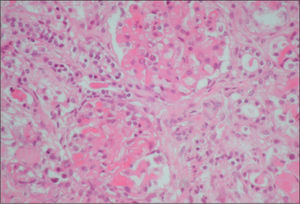 Microangiopatía trombótica glomerular.