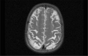 Resonancia magnética: lesiones inflamatorias corticales y subcorticales.