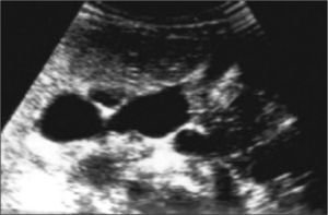 Imagen ecográfica de un riñón con displasia renal multiquística en el seno de un riñón “en herradura”.