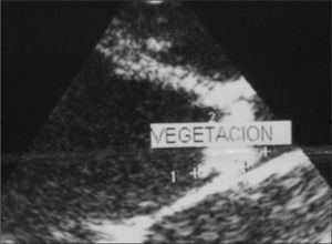 Hallazgo ecocardiográfico en el que se observa una vegetación en la válvula aórtica.