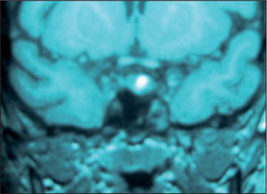Imagen del adenoma en corte sagital de la resonancia magnética.