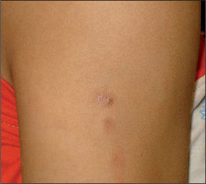 Lesiones induradas hiperpigmentadas y de aspecto cicatricial localizadas en la cara lateral externa del brazo derecho.