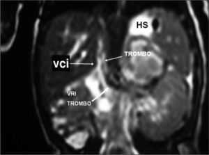 Angio-RM coronal en T2. Se observa ausencia de señal en la vena renal izquierda (que se extiende hasta la vena cava inferior, VCI) (flechas blancas). Hemorragia en suprarrenal izquierda (HS).