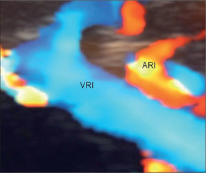 Ecografía Doppler en color realizada a los 14 días del ingreso en la que se observa la vena renal izquierda (VRI) repermeabilizada al lado de la arteria renal izquierda (ARI).