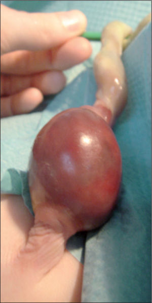 Hematoma del cordón umbilical. Obsérvese la tumoración rojo violácea, de 3 × 3 × 2cm, localizada a 1cm de la inserción del cordón umbilical a la piel.