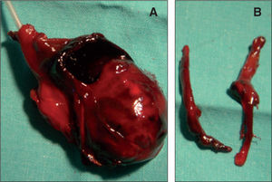 Análisis anatomopatológico de la pieza. La vena umbilical (A) estaba rota y presentaba un gran hematoma a su alrededor. Las arterias umbilicales (B) estaban íntegras.