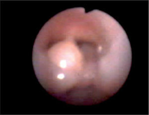 Engrosamiento de la mucosa del aritenoides izquierdo, que obstruye parcialmente la luz glótica durante la inspiración.