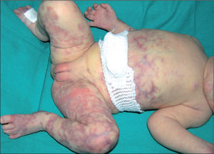 Lesiones reticuladas eritematovioláceas presentes al nacer características de cutis marmorata telangiectásica congénita (CMTC). Esta paciente, además, presenta un intenso dermografismo (véase el muslo izquierdo).