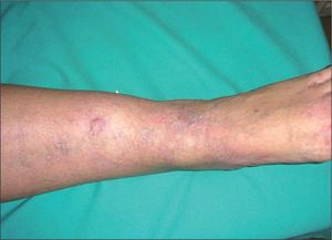 Atrofia cutánea sobre las lesiones de cutis marmorata telangiectásica congénita (CMTC).