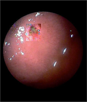 Imagen duodenoscópica en la que se observa una úlcera en la primera porción del duodeno.