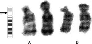 Cariotipo parcial (GTG) del paciente (A) y de la madre (B), que muestra el par de cromosomas 18. Se indica el punto de quiebra 18p11.21.