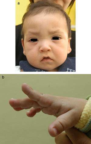 a: rasgos faciales de un varón de 11 meses con síndrome de Kabuki. b: persistencia del almohadillado fetal en el pulpejo de dedos de un varón de 11 meses con síndrome de Kabuki.