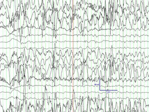 EEG con patrón de hemihipsarritmia.