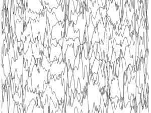 EEG con patrón de hipsarritmia.
