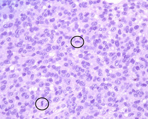 Histología a gran aumento del nódulo donde se observa alta densidad celular, con células de mediano tamaño sin atipia citológica y presencia de mitosis (círculo) (H-E, ×40).