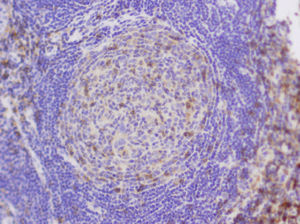 El tejido linfoide está principalmente formado por linfocitos B (CD20 positivos y CD79a positivos), de conformación anómala, y con una gran hiperplasia de células reticulares dendríticas, positivas para CD21 y CD23.