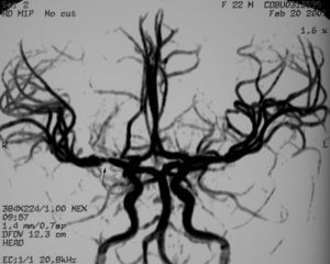 En la angio-RM 3DTOF, se aprecia lesión estenótica de margen irregular en el segmento M1 de la ACM derecha, que afecta a la salida de las arterias lenticuloestriadas.
