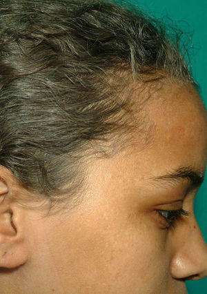 Detalle del característico cabello gris-plateado del SGP, en la paciente 1.