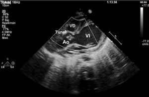 Eje paraesternal largo en 2D: ventrículo izquierdo (VI) y salida aórtica (Ao). Se aprecia el túnel VI-Aorta justo superior en la imagen al seno coronariano derecho.